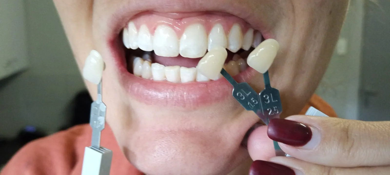 Shade guide 3L held against teeth during cosmetic consultation